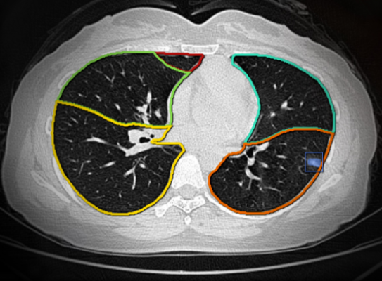 肺結(jié)節(jié)ct圖像輔助檢測軟件sensecare-lung