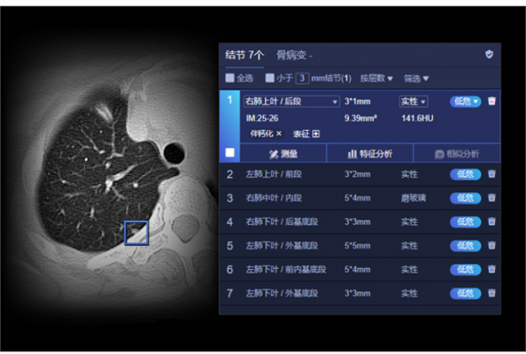 肺結(jié)節(jié)ct圖像輔助檢測軟件uai-pioneerchest聯(lián)影